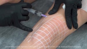 МАСТЕР-КЛАСС «Коррекция возрастных изменений области коленей с помощью COLLOST® micro»