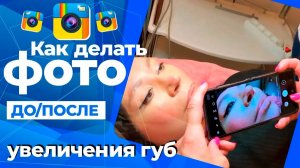 Как делать фотографии ДО/ПОСЛЕ увеличения губ