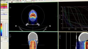 Synergy  s Stereotactic Radiosurgery