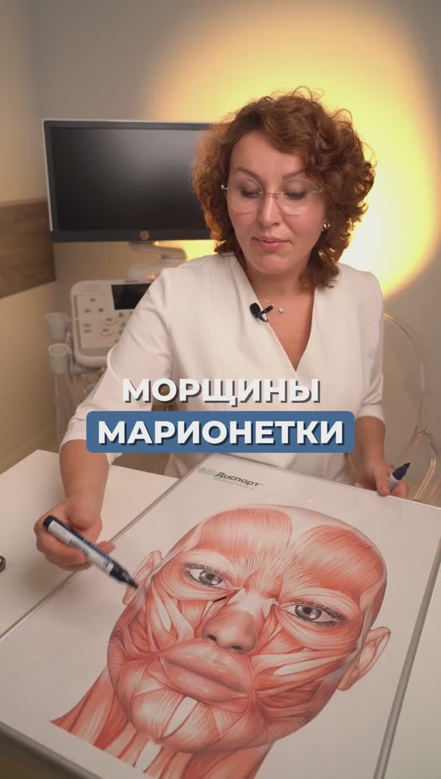 МОРЩИНЫ МАРИОНЕТКИ #инъекционнаякосметология #косметолог #ботокс