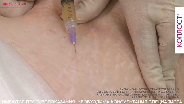 МАСТЕР-КЛАСС «Коррекция атрофических рубцов на теле с помощью коллагенового комплекса КОЛЛОСТ®»