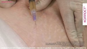 МАСТЕР-КЛАСС «Коррекция атрофических рубцов на теле с помощью коллагенового комплекса КОЛЛОСТ®»