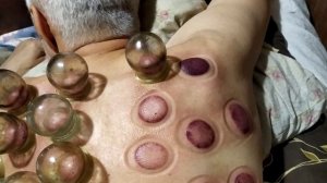 Поставили банки на 10 минут. Теперь  снимаем