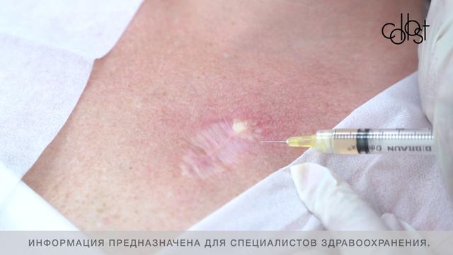 МАСТЕР-КЛАСС «Коррекция посттравматического рубца при помощи Коллост гель 7%» смотреть онлайн