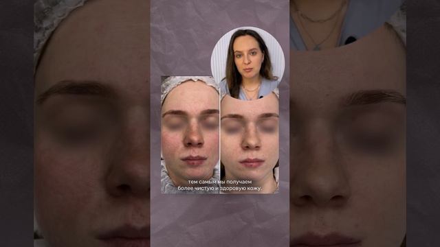 ЗАСТОЙНЫЕ ПЯТНА ПОСТАКНЕ. ПОМОЖЕТ ЛИ ФОТОЛЕЧЕНИЕ?
