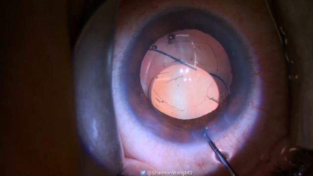 The Bausch and Lomb LI61AO Bent Haptic. How we fix it. смотреть онлайн