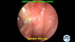 Киста Торнвальда (удаление лазером).