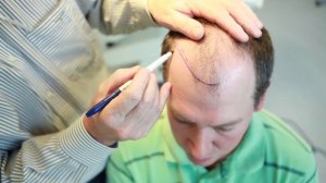 Diary of a hair transplant