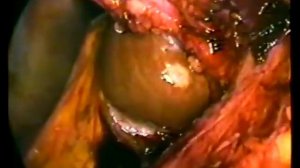 Laparoscopic gall bladder removal (cholecystectomy) - part 2 - Dr. Rossen