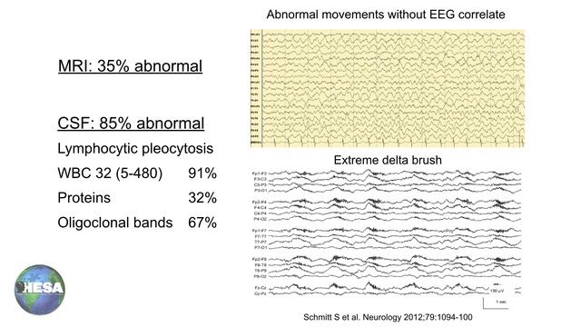Dr. Josep Dalmau speaker at "Autoimmune Encephalitis: The Bridge Between Neurology and Psychiatry" смотреть онлайн