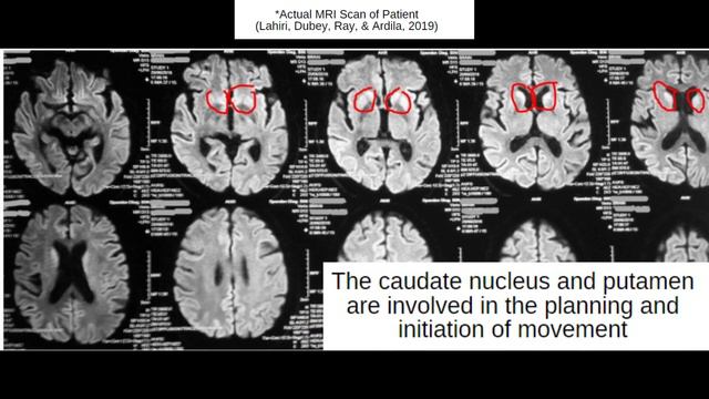 Creutzfeldt-Jakob Disease Case: A Brain Attacked By Abnormal Proteins | Extraordinary Brains #3 смотреть онлайн
