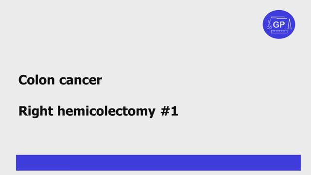 Colon cancer grossing #1