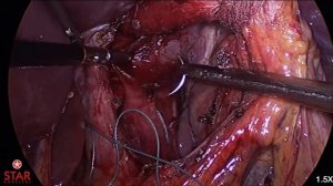 Laparoscopic Floppy Nissen's Fundoplication Teaching Video | Best Hospital Punjab India Top Surgeon