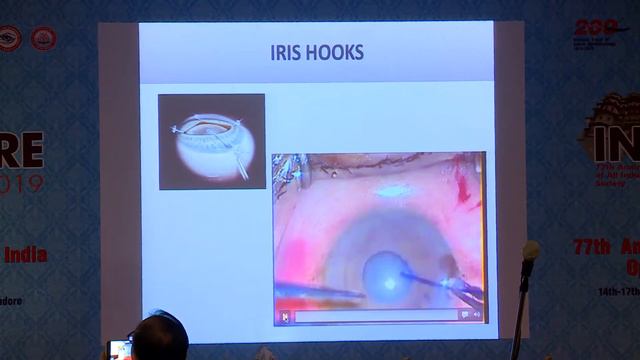 AIOC2019 GP89 Topic Using Devices to Enlarge Pupil Dr Shon Chinchole смотреть онлайн