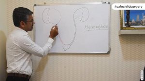 Antenatal Hydronephrosis - Dr. Manish Madhav(Part - II)