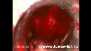 Удаление полипов  верхнечелюстной пазухи (эндоскопическая часть операции)