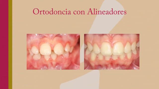 Ortodoncia - Clínica dental Miguel Ángel García смотреть онлайн