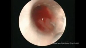 Эндоскопическая операция на верхнечелюстной пазухе