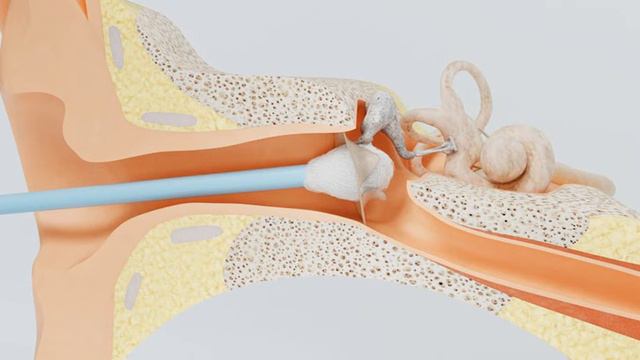Що робити, якщо заклало вухо смотреть онлайн