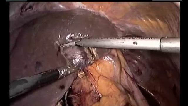 Leber Schlüssellochchirurgie Aalen, Professor Dr. Marco Siech смотреть онлайн