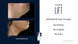 Laser Lift Procedure at Des Moines Plastic Surgery