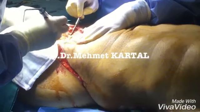 Karın Germe (Abdominoplasty Surgery) Ameliyatı Nasıl Yapılır? | Op. Dr. Mehmet Kartal смотреть онлайн