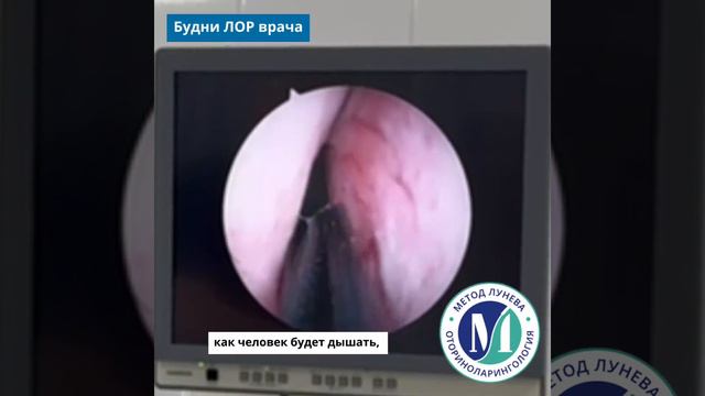 Искривление перегородки носа.