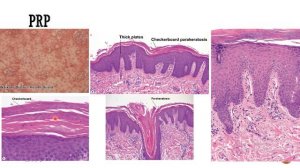 2- Psoriasiform Dermatoses -  DD (1)