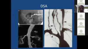 Renovascular Hypertension by Dr Ganesh Gopalakrishnan