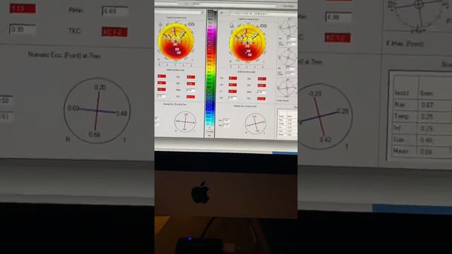 Keratoconus progression in a 44yoMale and hidden change in 22y/o woman: Kanellopoulos, MD смотреть онлайн