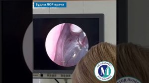 Удаление полипа носа лазером и шейвером.