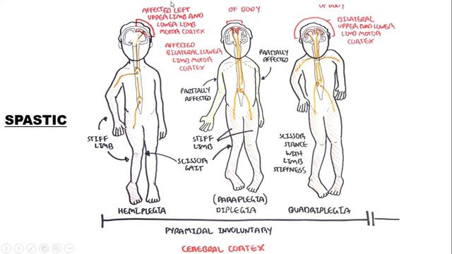 Cerebral Palsy by Siti Farah Adila - Discussion with Dr Zurina смотреть онлайн