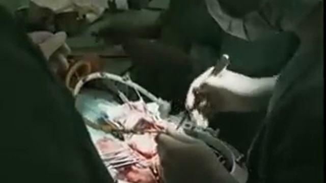 Tumorentfernung im Kopf - Εργαλειοδοσία Νευροχειρουργικής (Thrace-Greece) смотреть онлайн