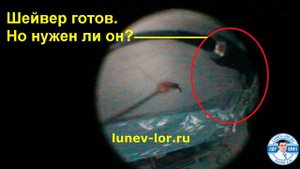 Полипы носа. Шейвер или петля. Чем лучше удалять полипы носа?