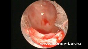 Эндоскопическая операция на верхнечелюстной пазухе