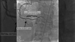 Селективная коронарография ПКА без патологии.

Проекция: правая косая с краниальной ангуляцией.
