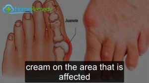 Reduce Bunion Pain with Home Remedies - Can you get rid of bunions without surgery?