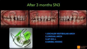 Treatment of CL III malocclusions in pediatric patients:  PLANAS DIRECT TRACKS FOR EARLY CORSS BITE