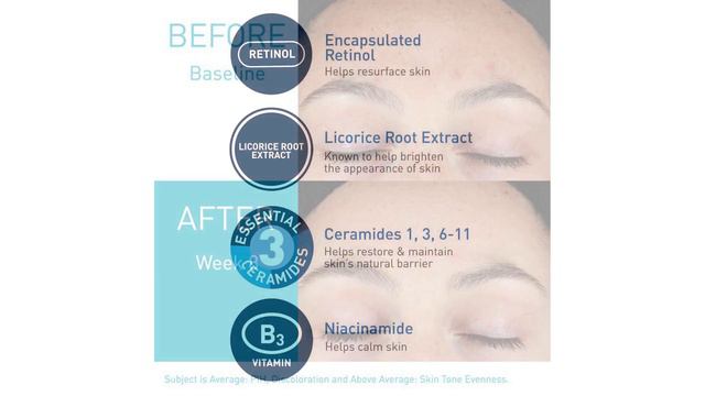 CeraVe Retinol Serum for Post Acne Marks Review смотреть онлайн