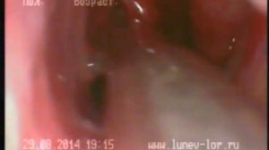 Удаление глоточной миндалины шейвером