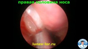 Удаление полипов носа шейвером. Шейвер или петля? Чем лучше удалять полипы носа.
