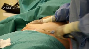 LIVE SURGERY: Mr Vasu Karri Performs a Brazilian Tummy Tuck (Lipoabdominoplasty)