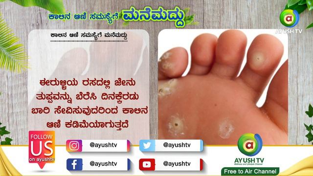 ಕಾಲಿನಲ್ಲಿ ಆಣಿ ಆಗಿದ್ದಲ್ಲಿ ಹೀಗೆ ಮಾಡಿ,  ಆಣಿ ಮಾಯವಾಗುತ್ತದೆ  | Mane maddu | Ayush TV смотреть онлайн