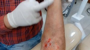 Arm Scar Treatment Results | Results Arm Cut Marks | Kayakalp Laser Clinic.