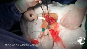 [20AGO21] DR. LUCAS DUARTE • Conventional Appendectomy - Apendicectomia Convencional