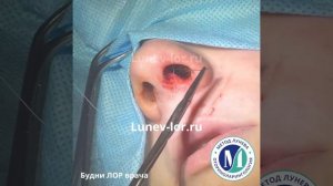 Септопластика.