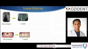 Delayed Replantation of avulsed teeth " Success or Failure" By Dr. Nizar Mujallid - OziDent Video