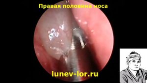 Полипы носа, удаление шейвером 13022018 с