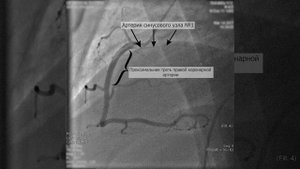 Селективная коронарография ПКА без патологии.

Проекция: левая боковая ( LAO 90)