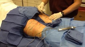 Cellulaze Procedure by Dr. David Berman of Sterling, Virginia